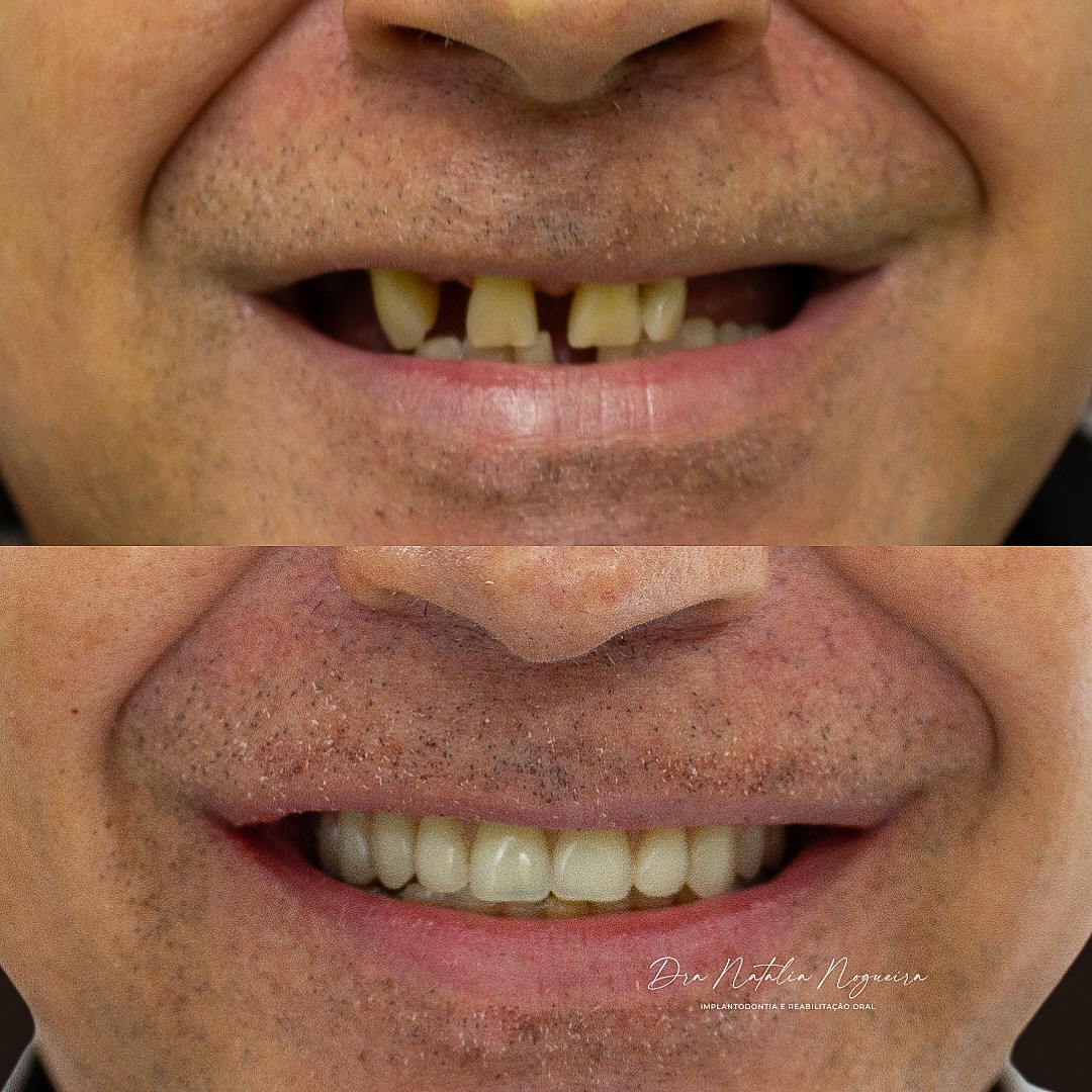 Transformação Funcional e Estética (antes e depois)